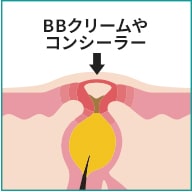 きちんと落とさないとアクネ菌が増殖