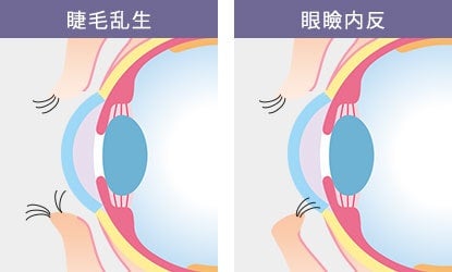 「睫毛乱生」と「眼瞼内反(睫毛内反)」